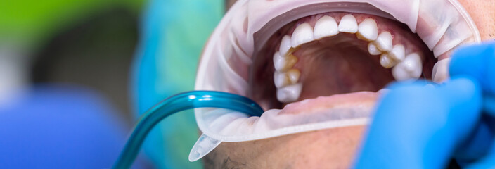 The dentist treats the patient's teeth, photo of the open mouth of the patient who came to the...