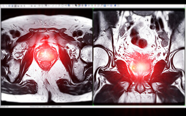 MRI of the prostate gland reveals Focal abnormal SI lesion at left PZpl at apex as described;...