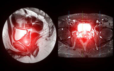MRI of the prostate gland reveals Focal abnormal SI lesion at left PZpl at apex as described; PI-RADS category 4, clinically