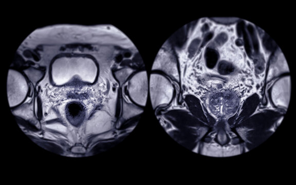 MRI of the prostate gland reveals Focal abnormal SI lesion at left PZpl at apex as described; PI-RADS category 4, clinically