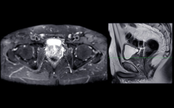 MRI of the prostate gland reveals Focal abnormal SI lesion at left PZpl at apex as described; PI-RADS category 4, clinically