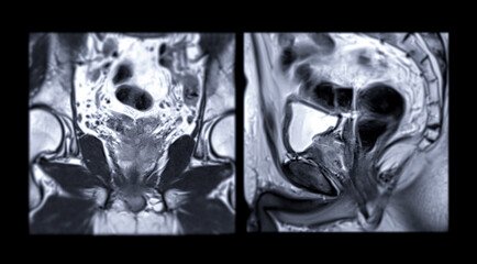 MRI of the prostate gland reveals Focal abnormal SI lesion at left PZpl at apex as described;...