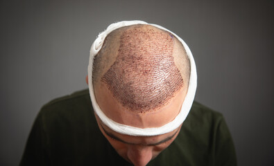 Caucasian man after hair transplantation. - 791337036