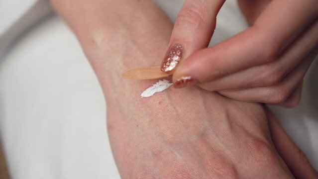 Close up, young woman uses bactericidal medical plaster on blister from burn which is smeared with therapeutic analgesic cream on hand. Female applying sterile plaster to treated seam on hand. Health