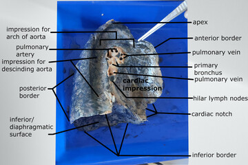 anatomy of left lung showing its surface, border and the features of its medial surface