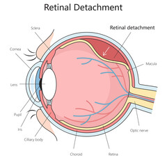 human eye anatomy showcasing retinal detachment, including cornea, lens, and optic nerve structure diagram hand drawn schematic raster illustration. Medical science educational illustration