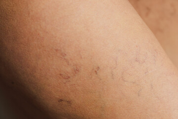 Varicose veins of small vessels on the skin of a woman's thigh.