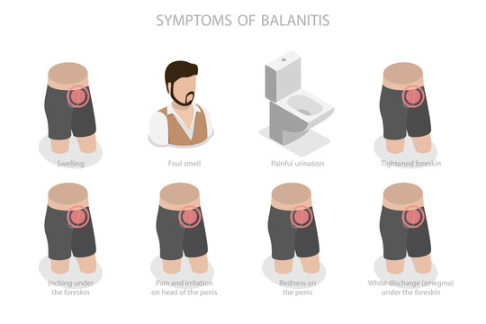3D Isometric Flat  Illustration of Symptoms Of Balanitis, Inflammation of the Frenulum