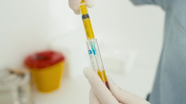 A close-up of how a doctor collects plasma from a test tube into a syringe. Carrying out cosmetology procedures for facial skin rejuvenation. High quality 4k footage