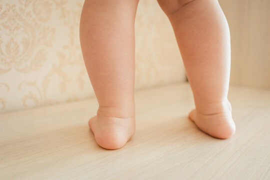 hallux valgus in a child