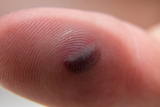 Blood blister under the thumb skin. Caucasian young man finger on white background.