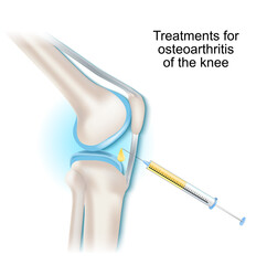 Treatments for osteoarthritis of the knee joint.