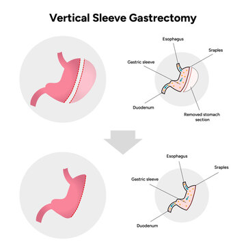 Vertical Sleeve Gastrectomy 