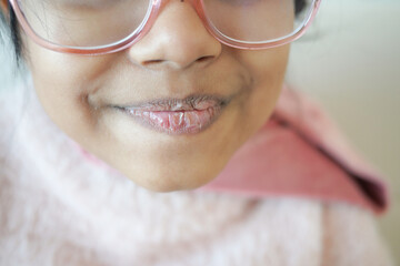 close up of dry lip of a child 