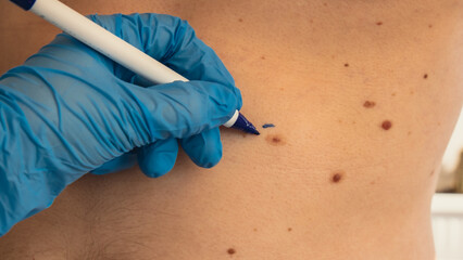 Doctor in medical gloves paint lines around male birthmarks. Preparing procedure for medical...