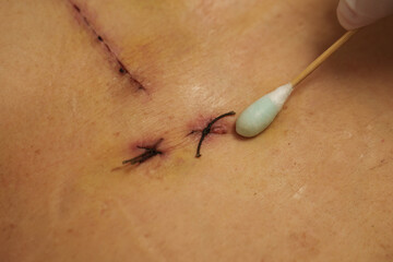 doctor using alcohol and cotton bud cleaning wound from open heart surgery on female body (Heart Valve Regurgitation)
