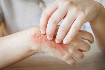 severe hand itching scratching. scary wound Itchy rash, allergies, fungal skin diseases - 792644858
