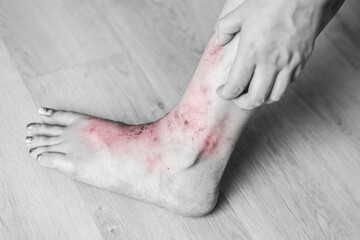 severe leg feet itching scratching. scary wound Itchy rash, allergies, fungal skin diseases