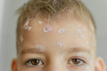 chickenpox on the face of a small child. skin disease. a childhood infection. treatment of...
