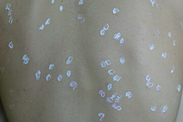 a chickenpox rash on the body of a young man. chickenpox. traces of the disease. skin disease