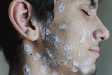 a chickenpox rash on the face of a young man. chickenpox. traces of the disease. skin disease