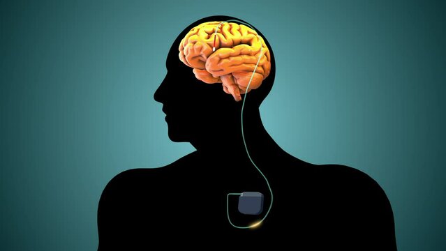The medical notion of deep brain stimulation