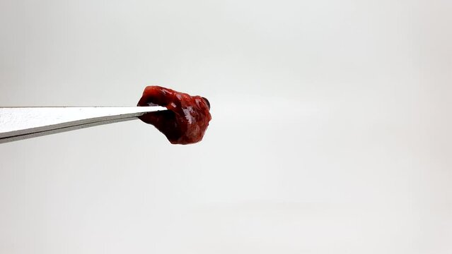There's a clot in the forceps. Blood clot, lump in medical forceps.