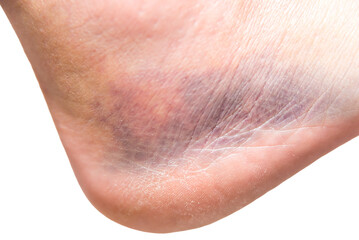 close up of heel with injury, sprain, strain, inflammation, bruise, edema, medicine, rehabilitation