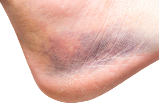close up of heel with injury, sprain, strain, inflammation, bruise, edema, medicine, rehabilitation
