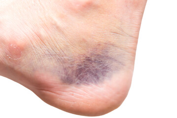 close up of heel with injury, sprain, strain, inflammation, bruise, kinesiology