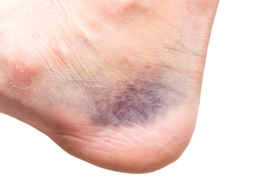 close up of heel with injury, sprain, strain, inflammation, bruise, kinesiology