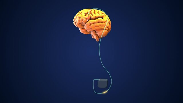 Deep brain stimulation as a medical concept