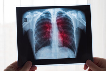 Lung radiography concept. Radiology doctor examining at chest x ray film of patient Lung Cancer or Pneumonia. Virus and bacteria infected the Human lungs. Patient with Lung Cancer or Pneumonia