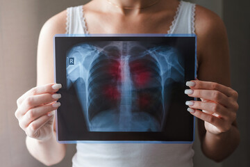 Lung radiography concept. Virus and bacteria infected the Human lungs. Patient with Lung Cancer or...