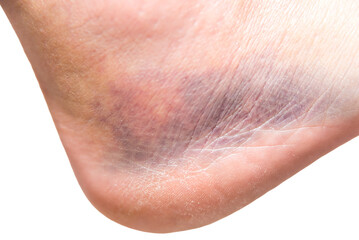 close up of heel with injury, sprain, strain, inflammation, bruise, edema, medicine, rehabilitation