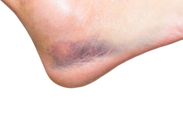 close up of heel with injury, sprain, strain, inflammation, bruise, kinesiology - obrazy, fototapety, plakaty