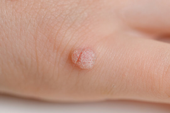 Common wart on hand, flat wart, close-up, Verruca vulgaris. Human papillomavirus, HPV.