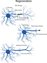 An attempt at nerve fiber regeneration. Damage and degeneration of the nerve fiber.