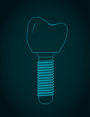 Dental prosthesis blueprint - 793369000