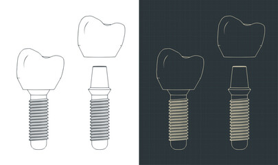 Dental prosthesis blueprints - 793369024