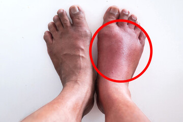 Compare swollen feet from tick bites with normal feet on white background back, enlarged image in...
