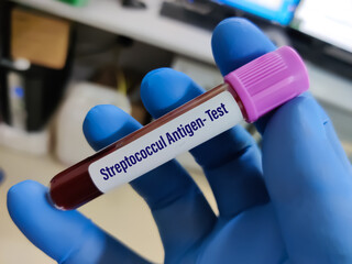 Blood sample for Rose Waaler test
