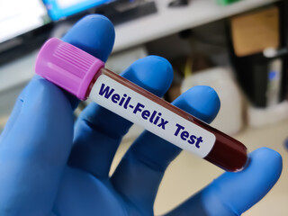 Blood sample for Weil-Felix test