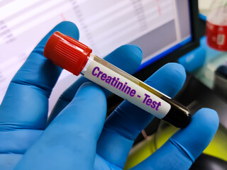 Blood sample for serum creatinine test. To diagnosis liver disease.