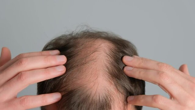Man with hair loss problems close-up. Close-up of a young man with alopecia on a gray background.