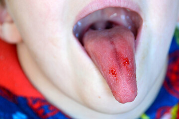  Close-up of lips, tongue, protrusion of blood. Child's bitten tongue.