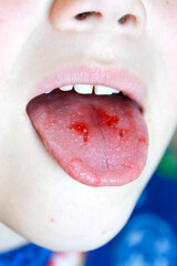 Obraz premium Close-up of lips, tongue, protrusion of blood. Child's bitten tongue.