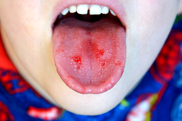  Close-up of lips, tongue, protrusion of blood. Child's bitten tongue.