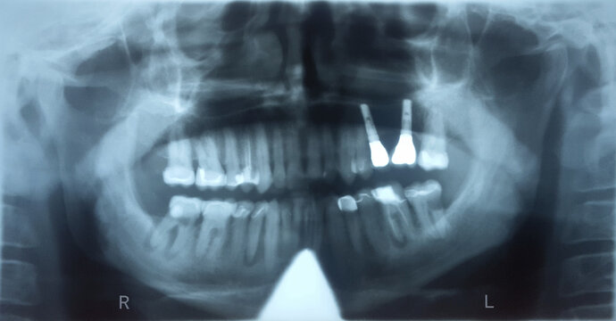 Röntgenaufnahme, Zahnarzt