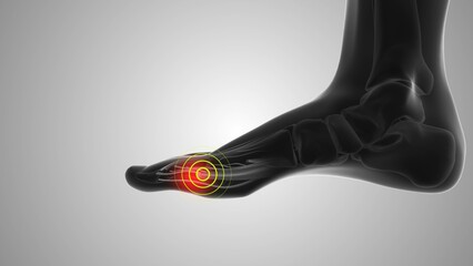 MTP joint discomfort that triggers pain